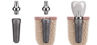 dental implant process in Indianapolis