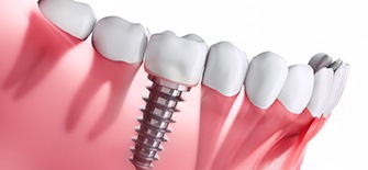 implant placement with an implant dentist in Indianapolis 