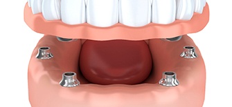 dentures attaching to dental implants in Indianapolis