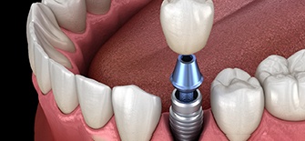 Render of a single dental implant in Indianapolis, IN, and a crown