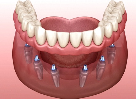 A diagram of how an implant-retained denture works.