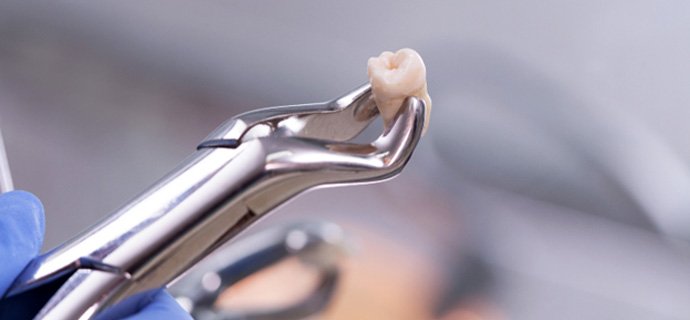 forceps holding an extracted tooth in Indianapolis