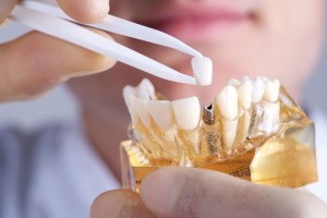 Dental implants in Indianapolis are a durable solution