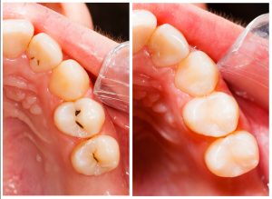 Teeth with cavities before and after fillings