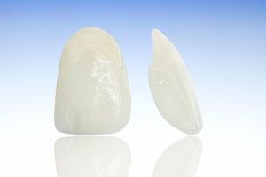 white thin porcelain veneers shells