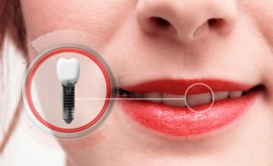 Woman with dental implant